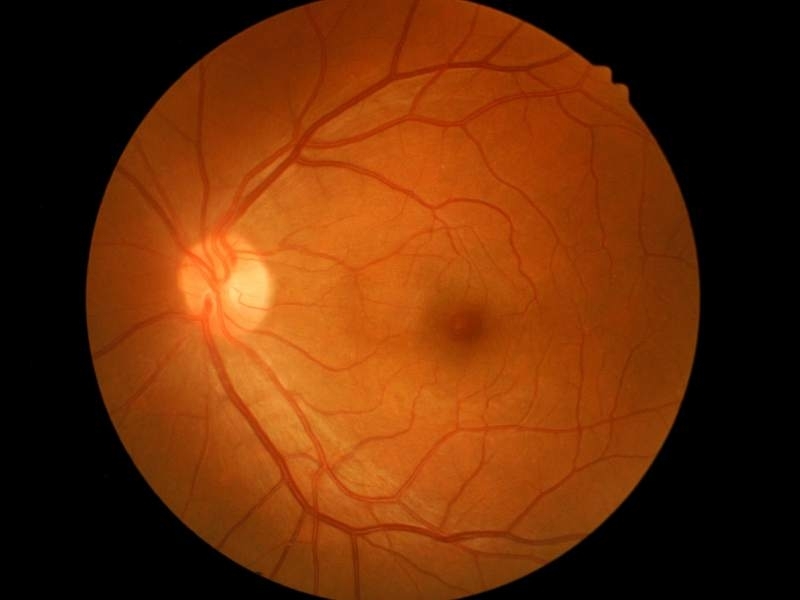 Estereofoto de papila: Retinografia