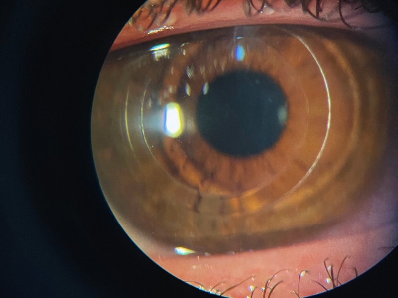 Mapeamento de Retina